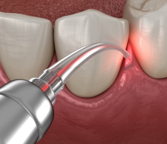 Illustrated dental laser treating gum disease