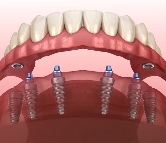 Illustrated full denture being placed over six dental implants