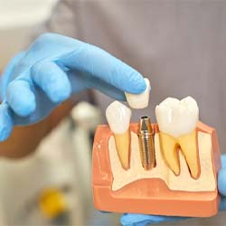 dentist holding a model of how dental implants work in Waco