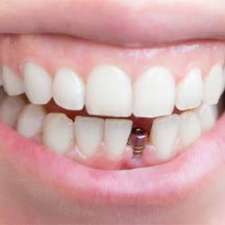 person smiling with a visible dental implant abutment