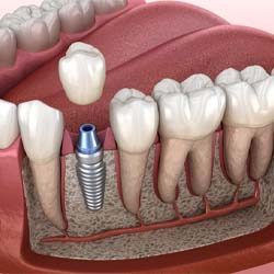 dental crown being placed onto a dental implant in the lower jaw