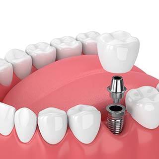 Diagram of how dental implants in Waco work