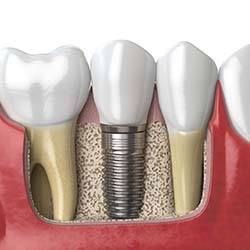 Diagram showing dental implants in Waco after surgery