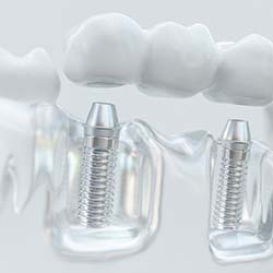 Model showing implant bridge replacing multiple missing teeth in Waco