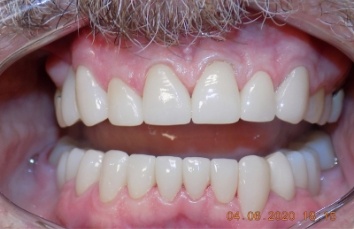 A beautiful smile after cosmetic work