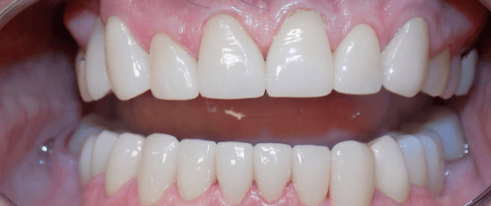 A beautiful smile after cosmetic work