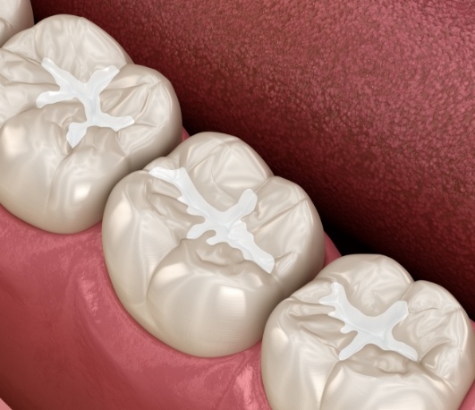 Illustrated row of teeth with white dental sealants