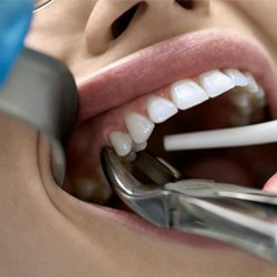 a patient undergoing a tooth extraction in Waco