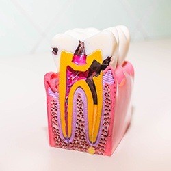 plastic model of tooth and gums