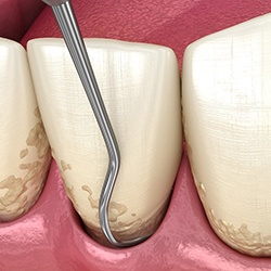 3D illustration of scaling and root planing