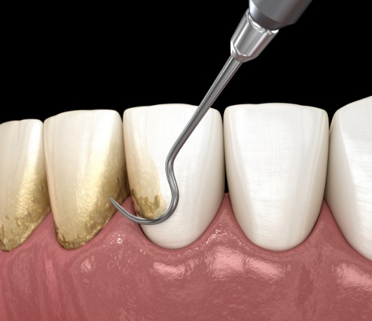 Illustrated dental scaler clearing plaque buildup from teeth