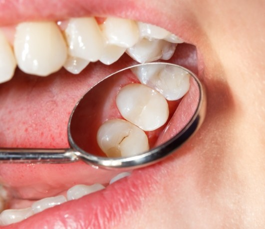 Close up of dental mirror inside mouth reflecting a tooth