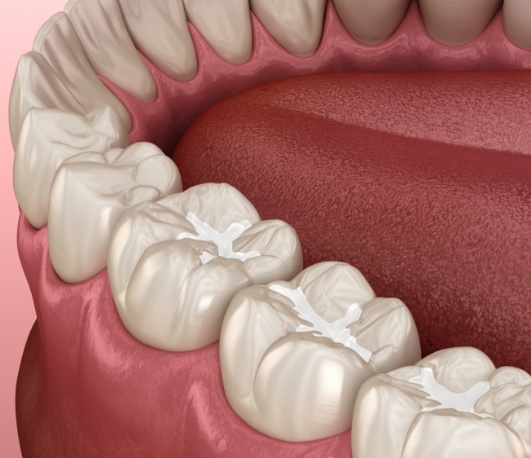 Illustrated row of teeth with white fillings