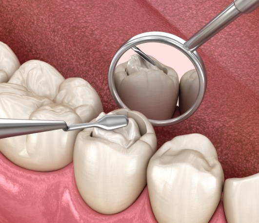 Illustration of a tooth colored filling being placed on a tooth