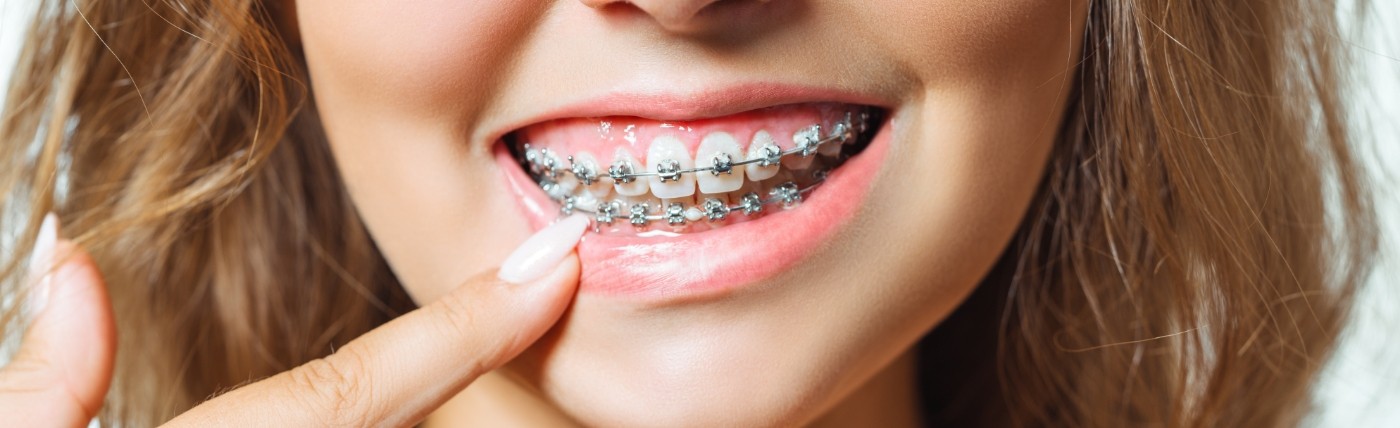 Close up of person pointing to their smile with traditional braces in Waco