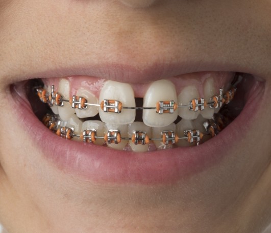 CLose up of smile with traditional braces and orange brackets
