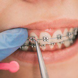 pink traditional braces