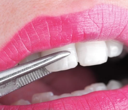 Close up of a veneer being placed over a tooth