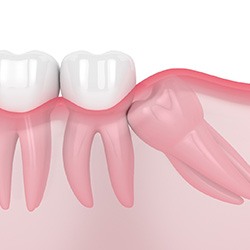 3D render of a wisdom tooth