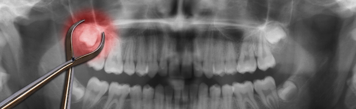 Dental x ray with an impacted wisdom tooth highlighted red