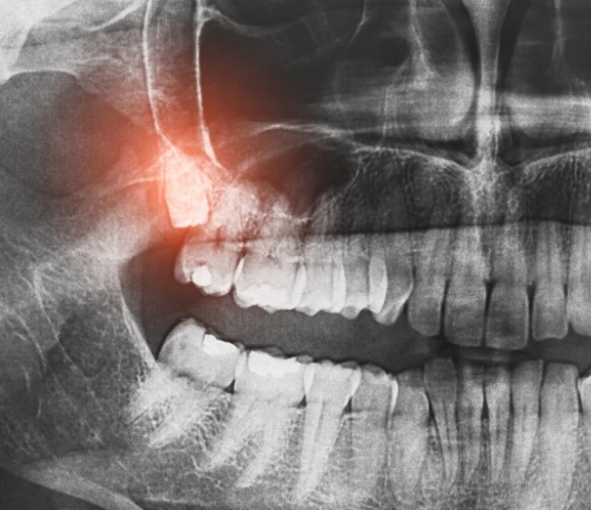 X ray of teeth with impacted wisdom tooth highlighted red