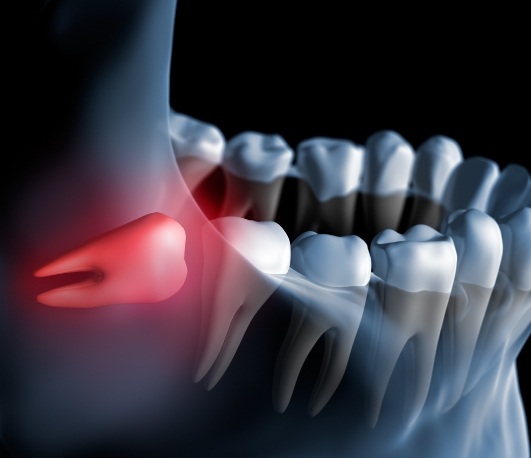 Illustration of impacted wisdom tooth pressing against adjacent tooth