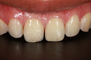 porcelain veneers waco tx