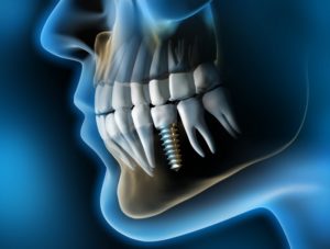 X-ray of dental implant