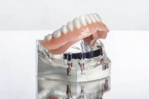 implant-retained denture