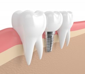 Dental Implant