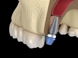 Dental implant after a bone graft in Waco.