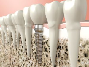 Image of dental implant supporting jawbone preservation.