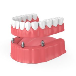 3D implant dentures illustration 