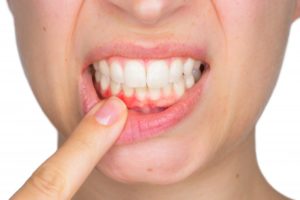 inflamed lower gingiva pain expression