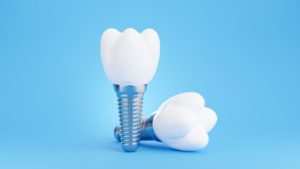 dental implant 