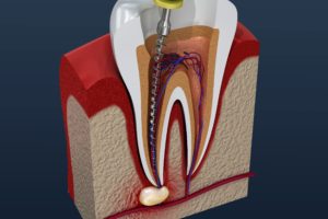 Root canal on infected tooth
