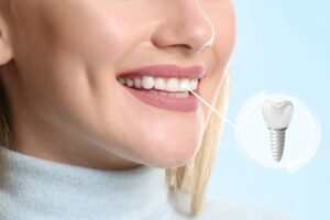 Dental implant.