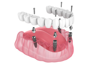 Illustration of dentures being attached to All-on-4 dental implants
