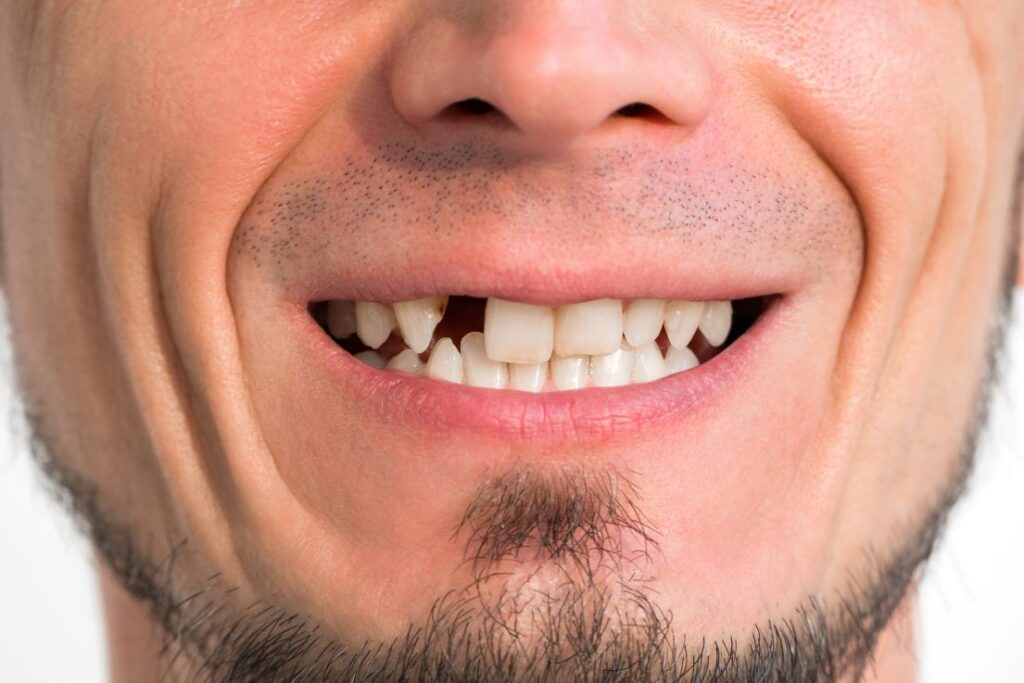 A man missing a front tooth